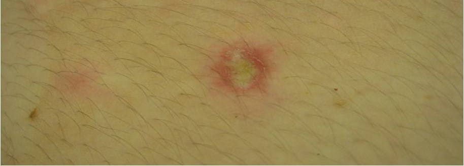 Degos Disease - Symptoms, Causes, Treatment | NORD